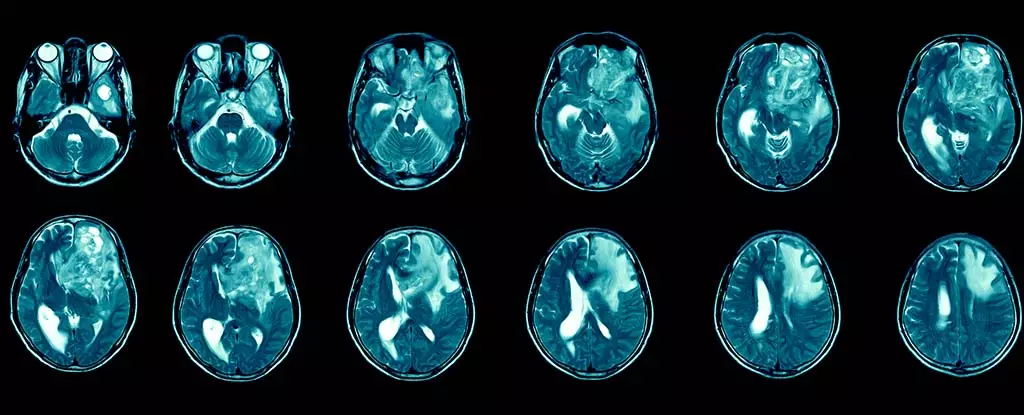 Revolutionizing Glioblastoma Treatment: The Promise of Immunotherapy