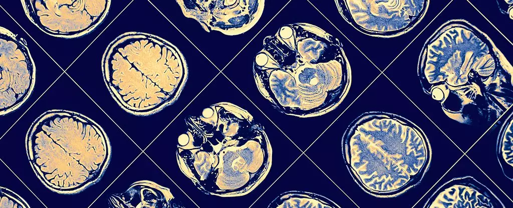 Unraveling the Mystery of Resilience Against Alzheimer’s: A Singular Case Study