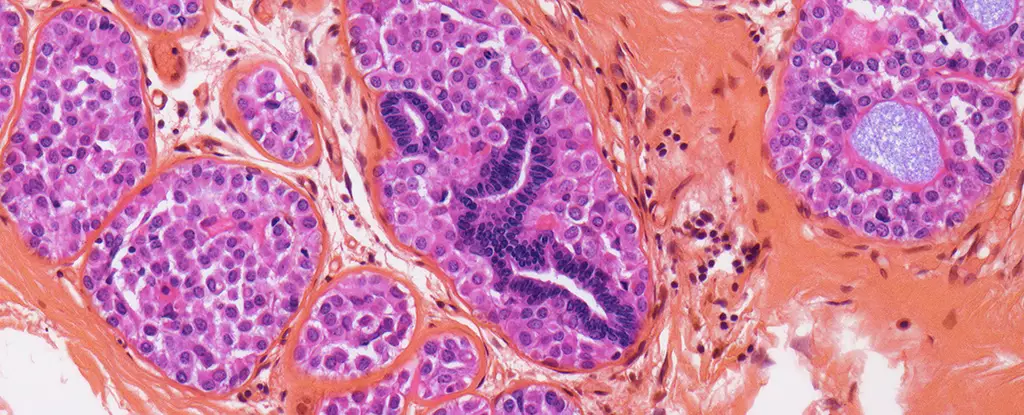 Unveiling Hope: How Breast Cancer Survival Might Reduce Alzheimer’s Risk